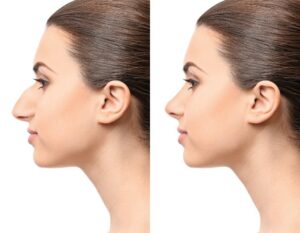 Rhinoplasty