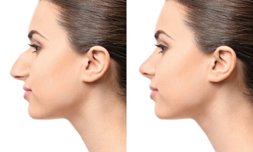 Best Rhinoplasty Chicago: Real Patient Stories and Transformations